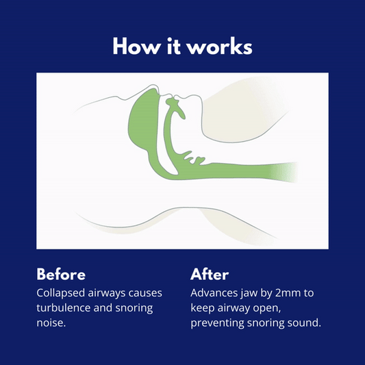 Anti-Snoring Mouth Guard