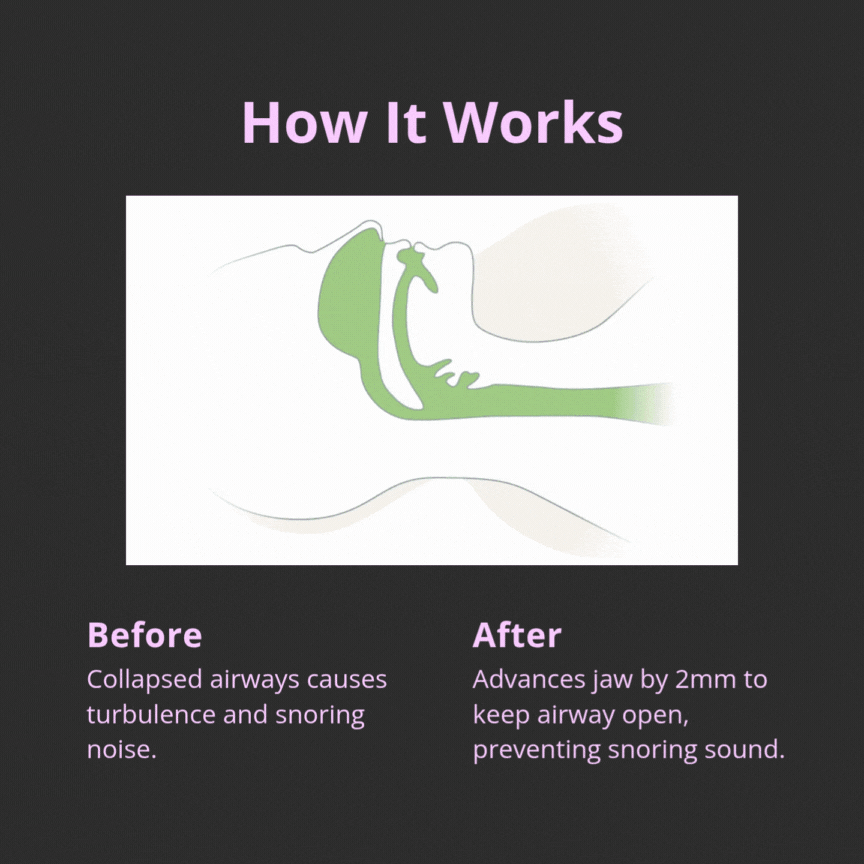 Anti Snoring Mouth Guard
